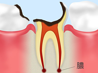 C4：歯の根の虫歯
