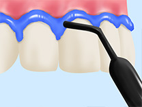 STEP2歯ぐきの保護